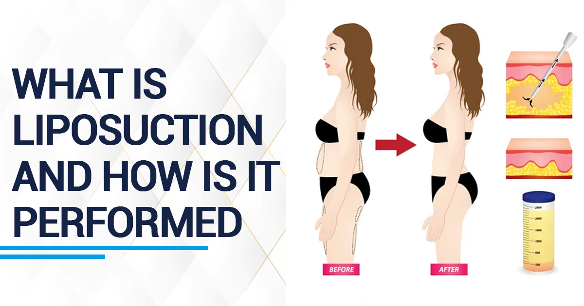 What Is Liposuction And How Is It Performed?
